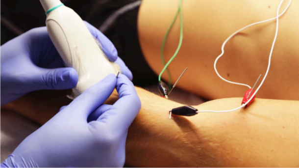Fisioterapia Invasiva 2 neuromodulacion-percutanea-ecoguiada